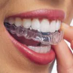 Fairywill Moldable Mouth Guard